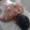 Cupping