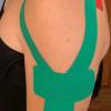 Kinesio taping