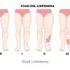 I tre stadi del Linfedema