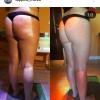 Coppettaazione per inestetismi cellulite. Risultato dopo 8 sedute 